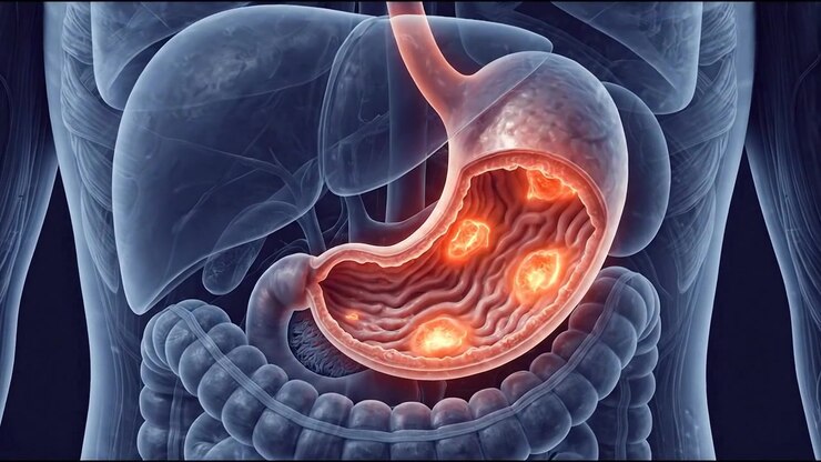 Medical Animation of Human Stomach with Inflamed Ulcers