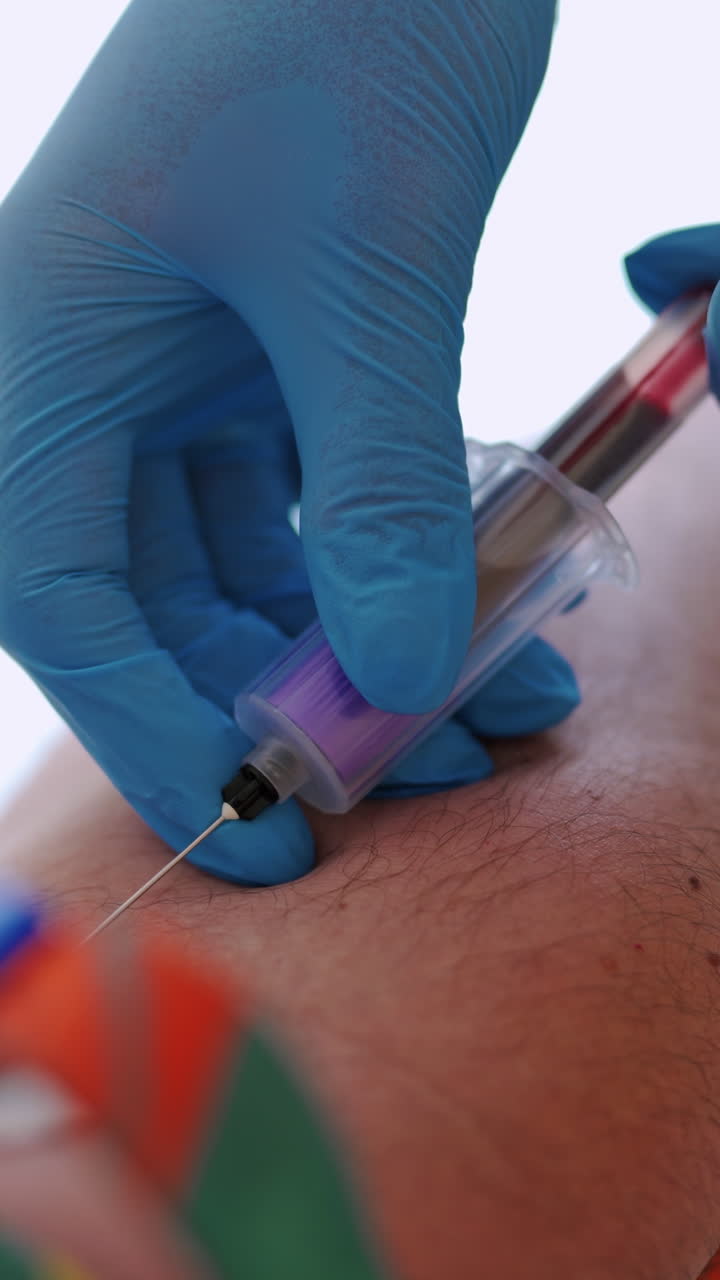 Close-up view of a needle on man's arm to collect blood into syringe. Medical worker in gloves taking blood sample from vein. Vertical video