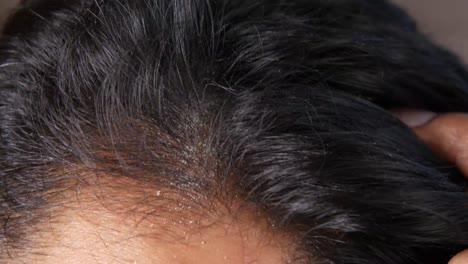 dandruff on scalp