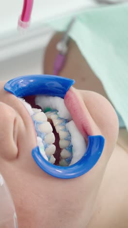 woman undergoing professional teeth whitening procedure at dental clinic, close up