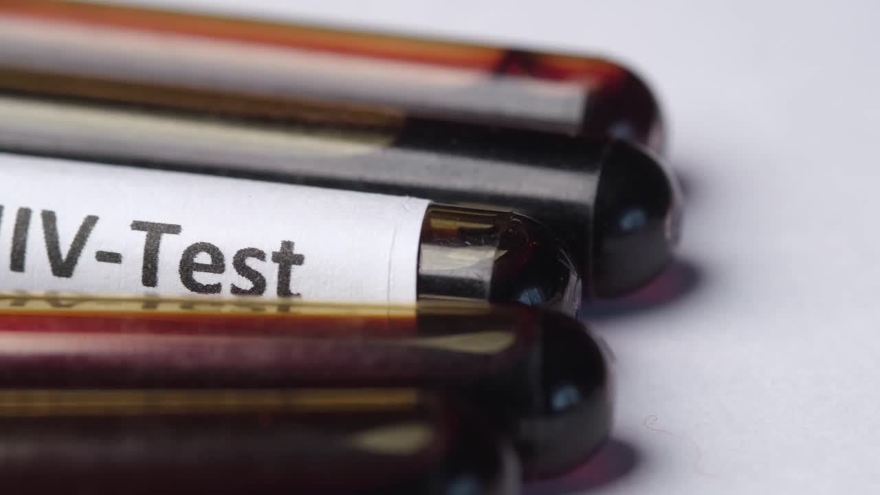 실험실에서 hiv 검사