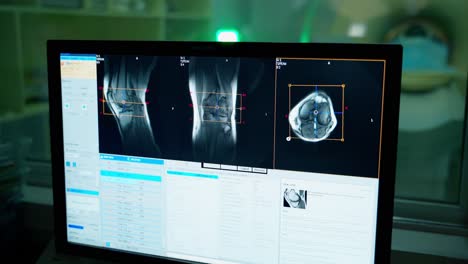 x-rays on a computer screen in a laboratory room. doctor radiologist examines radiographic shots of the patient's bones on the screen of a monitor.