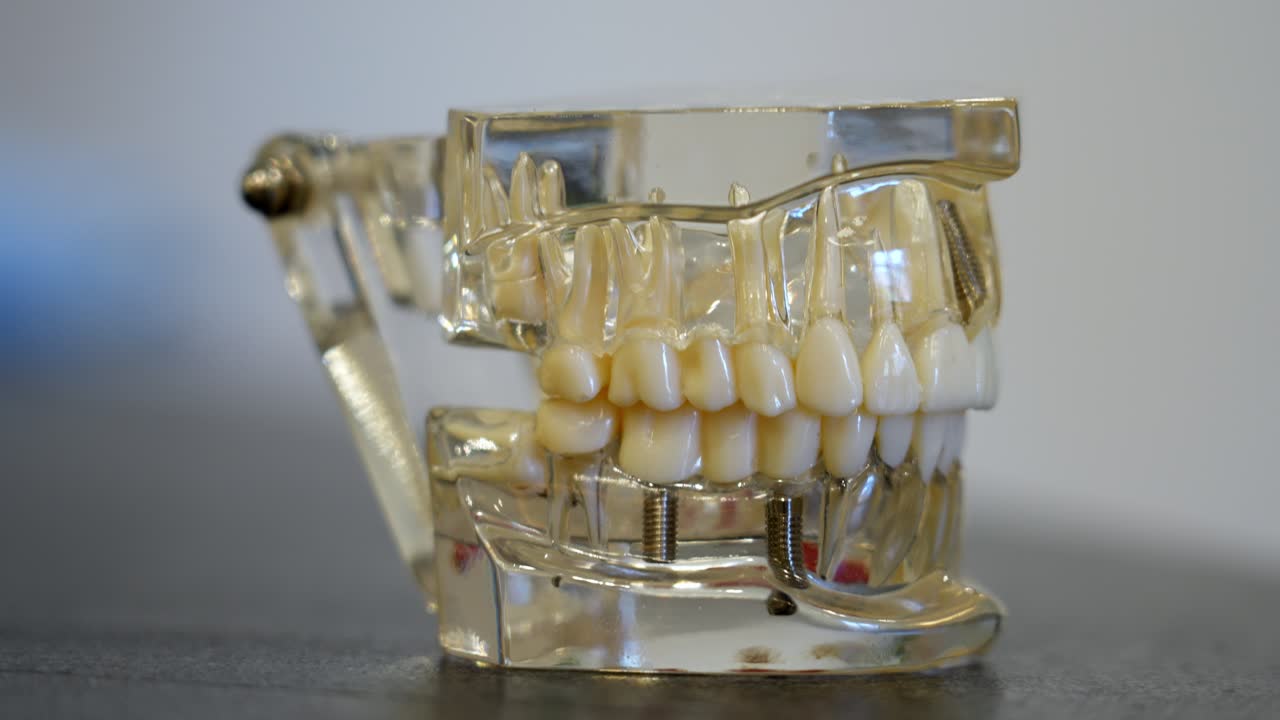 Transparent jaw model showing teeth and implants
