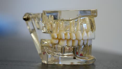 transparent jaw model showing teeth and implants