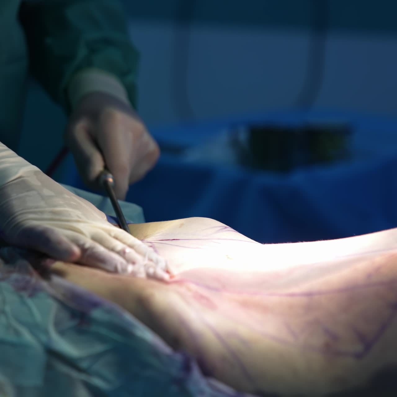 Surgeon does liposuction for patient in medical clinic. Doctor collects fat from patient's belly. Surgical removal of fat tissue from the abdomen. Close-up