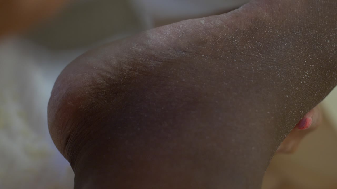 오른발 발 뒤꿈치에서 죽은 피부를  ⁇ 는 것