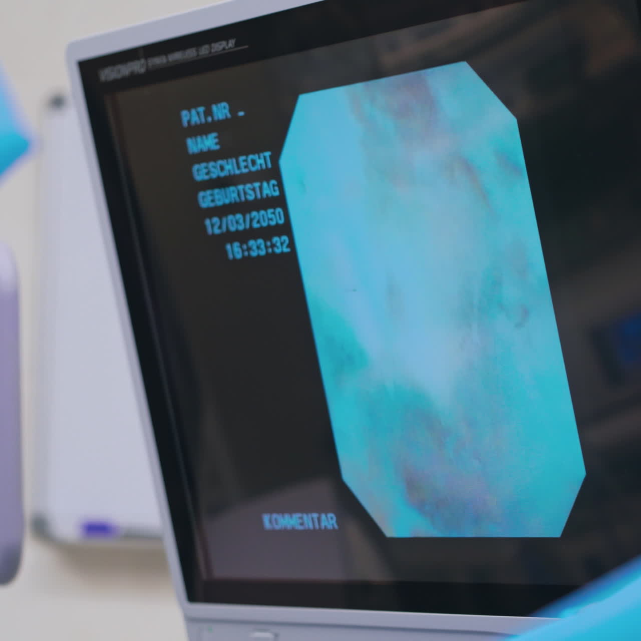 Endoscopic surgery on a display in hospital. Laparoscopic operation on the screen of a modern monitor in the operating room. Close-up.