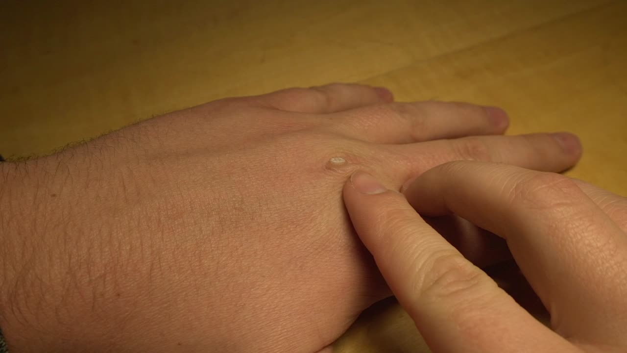 Pinching wart on man's left hand.
