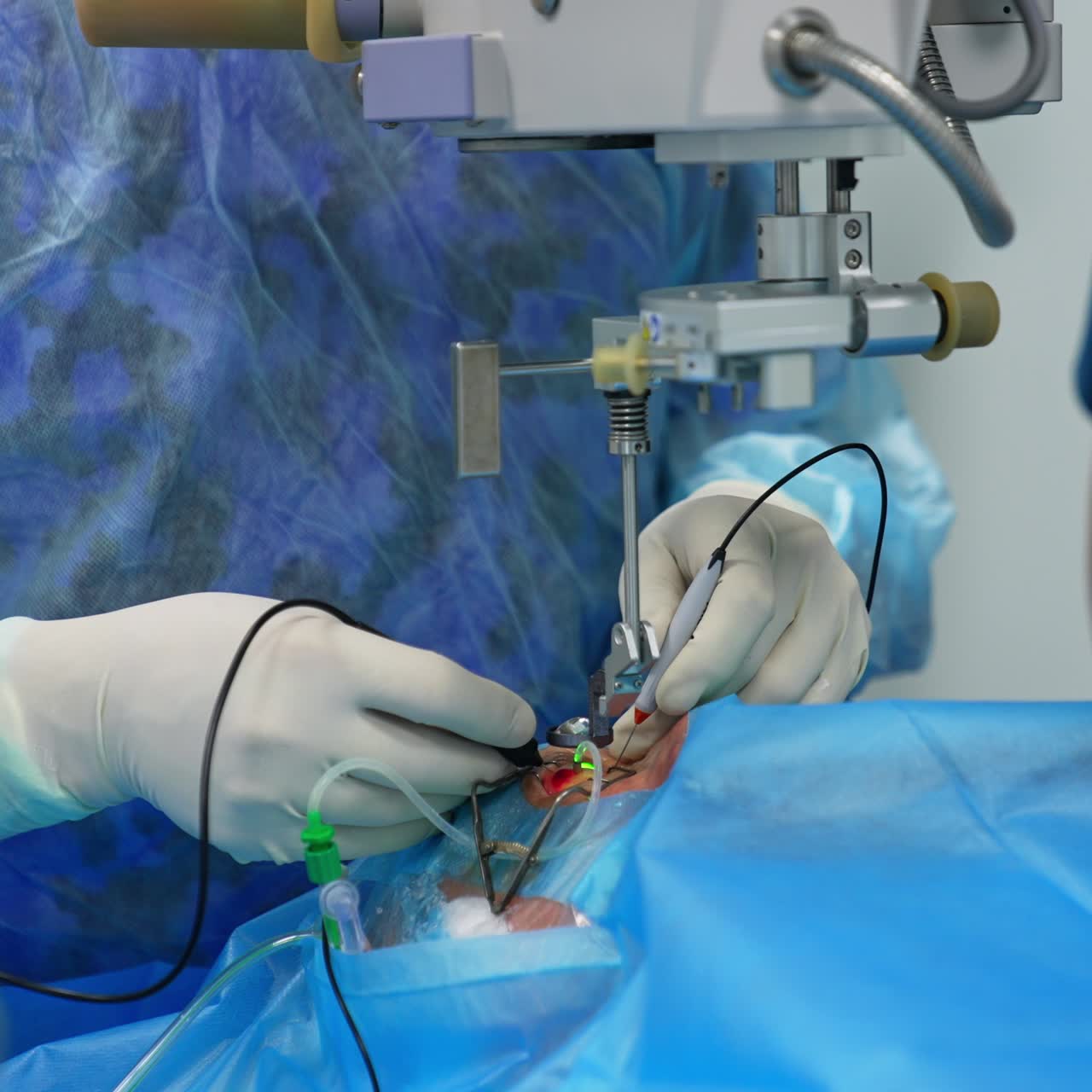 Eyesight correction operation in modern clinics. Doctor applies instrument holding them in both hands to the patient's eye highlighted with red lamp