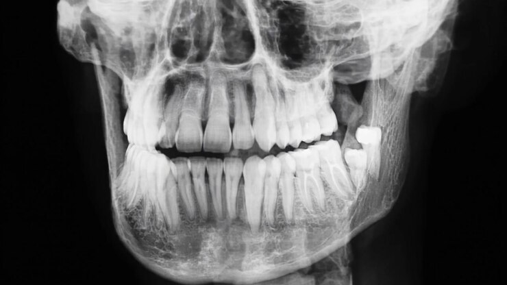 Panoramic Dental X-ray Showing Human Jaw and Teeth