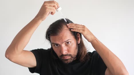 Mann,-Der-Minoxidil-Mit-Einer-Pipette-Ins-Haar-Einträgt,-Kahlheit,-Haarwiederherstellung