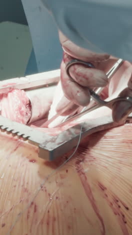 el cirujano corta el hilo en la cavidad torácica. los médicos se preparan para extirpar los esparcidores de costillas del cuerpo después de la cirugía de derivación de la arteria coronaria en la sala de operaciones