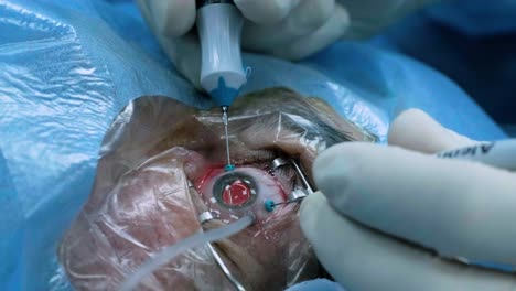 eye surgery, vitreoretinal. vitrectomy surgery.