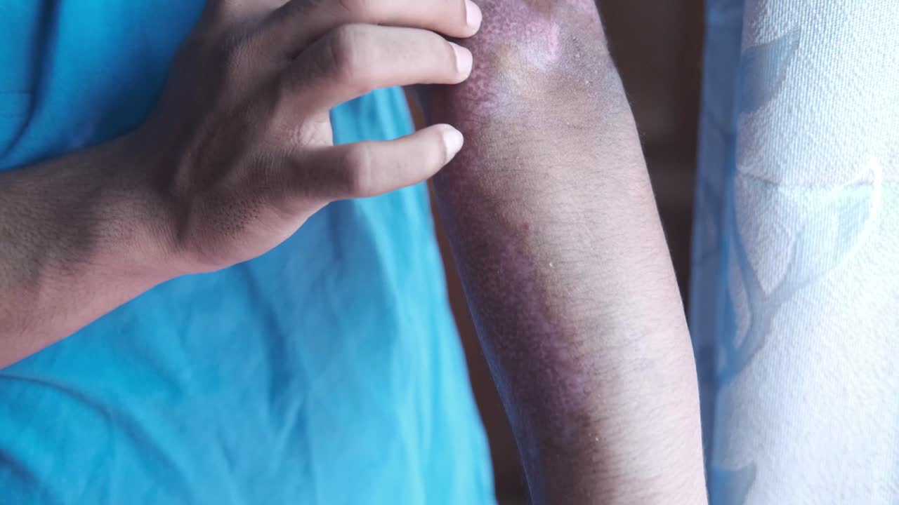 persona con erupción cutánea en el brazo