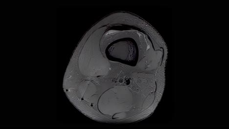 mri scan of an injured male knee, scanning from top to bottom