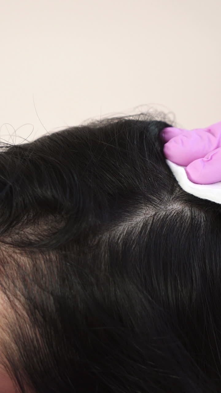 Needle mesotherapy. Cosmetic been injected in woman's head. Thrust to strengthen hair and their growth Vertical video