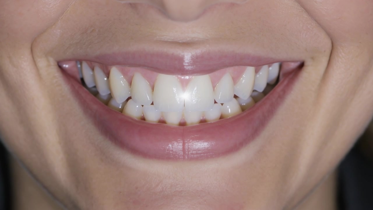 Smiling woman revealing stained front teeth and glossy lips in studio flash flashing creating flare