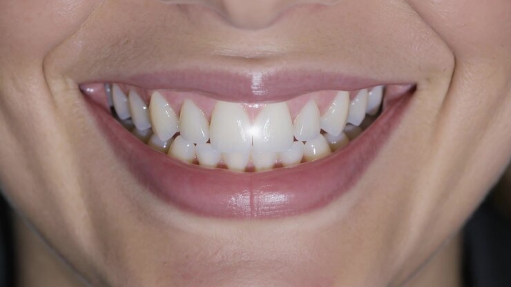 Donna sorridente che rivela i denti anteriori macchiati e labbra lucide, con un flash da studio che lampeggia creando un bagliore