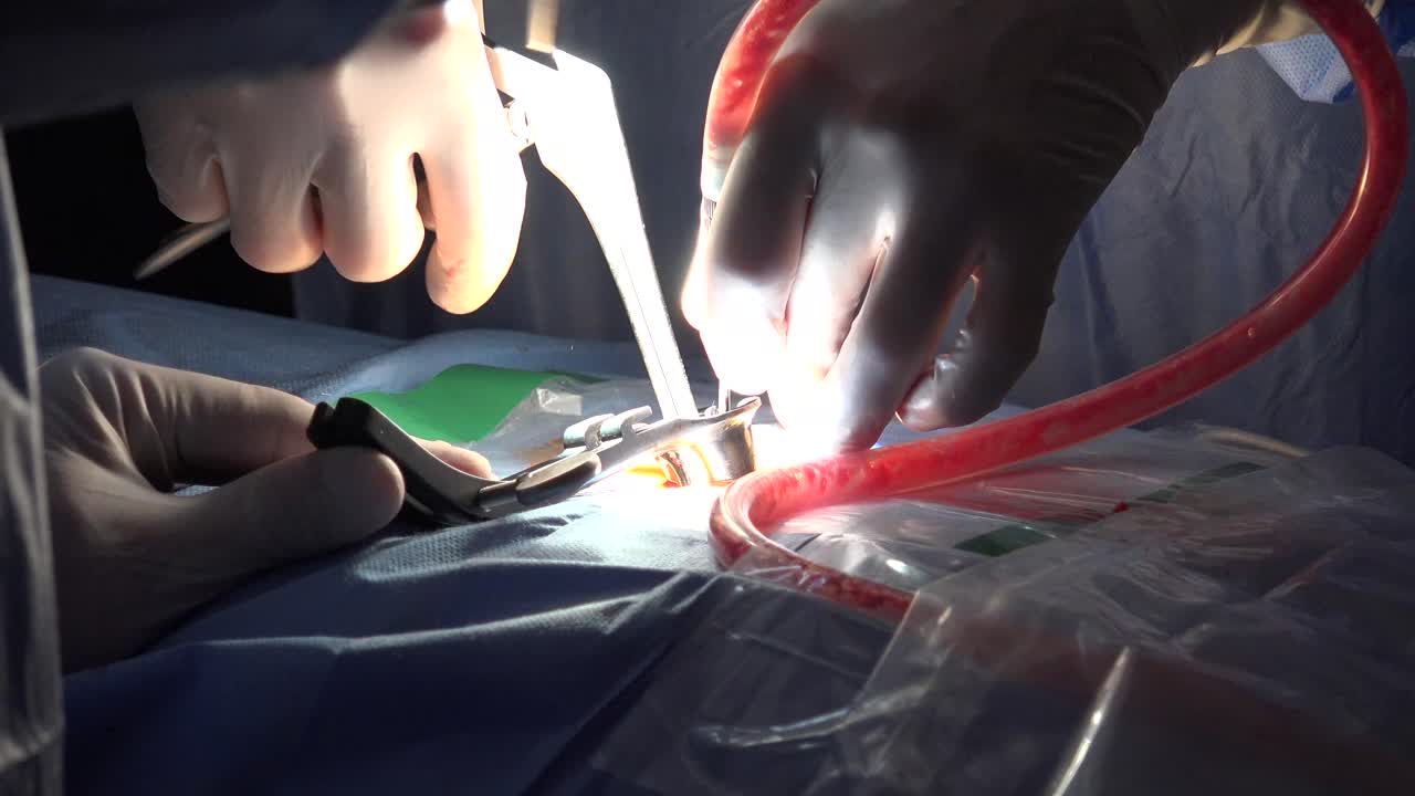 Spinal disc herniation is an injury to the cushioning and connective tissue between vertebrae, usually caused by excessive strain or trauma to the spine