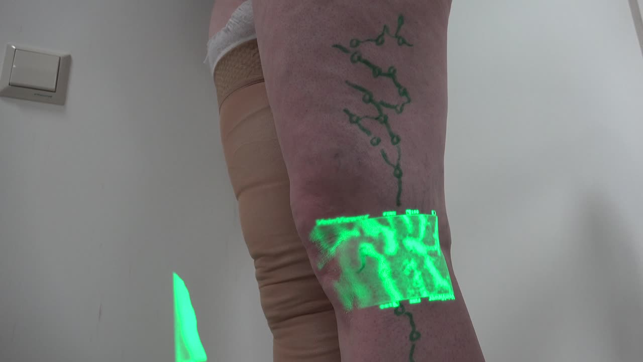 el cirujano vascular está marcando venas para cirugía varicosa.